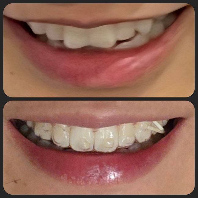 Comparison photo from before Invisalign treatment to now, where butterfly incisors are significantly reduced and bite is being corrected.